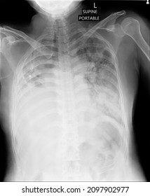 Pulmonary Edema Or Lung Congestion