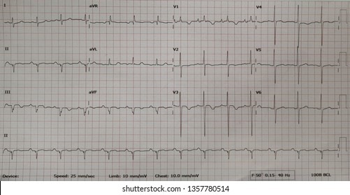 Pulmonary Hypertension. RVH. RV Pressure Load.