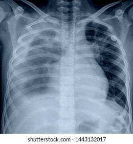 Pulmonary Radiography Pleural Effusion Stock Photo 1443132017 ...