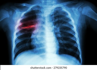 Pulmonary Tuberculosis ( Chest X-ray of child : show patchy infiltration at right middle lung )