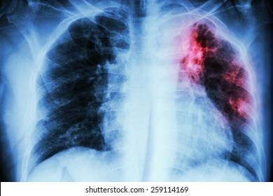 Pulmonary Tuberculosis . Chest X-ray : interstitial infiltration at left upper lung due to Mycobacterium Tuberculosis infection