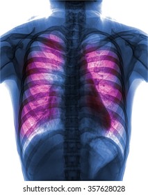 Pulmonary Tuberculosis Chest Xray Interstitial Infiltration Stock Photo ...