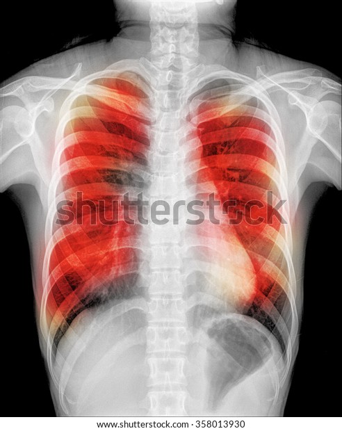 Pulmonary Tuberculosis Chest Xray Interstitial Infiltration Stock Photo ...