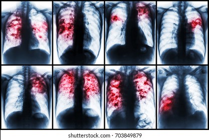 Pulmonary Tuberculosis Collection . Chest X-ray show patchy infiltration , interstitial infiltration , alveolar infiltration , cavity , fibrosis at lung due to Mycobacterium tuberculosis infection .