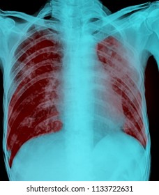 Pulmonary Tuberculosis Film Xray Chest Show Stock Photo Shutterstock