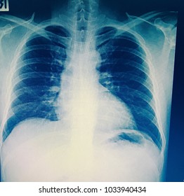 Pulmonary Tuberculosis ( TB ) : Chest x-ray show alveolar infiltration at both lung due to mycobacterium tuberculosis infection