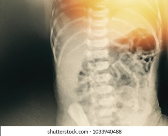 Pulmonary Tuberculosis ( TB ) : Chest x-ray show alveolar infiltration at both lung due to mycobacterium tuberculosis infection