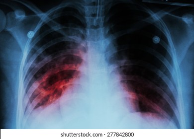 Pulmonary Tuberculosis ( TB ) : Chest x-ray show alveolar infiltration at both lung due to mycobacterium tuberculosis infection