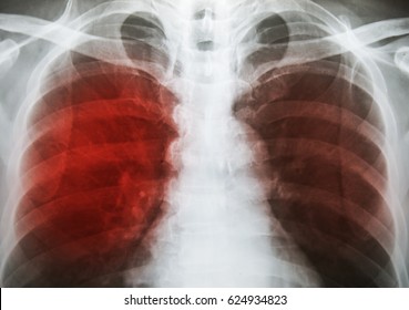 Pulmonary Tuberculosis ( TB ) : Chest x-ray show alveolar infiltration at both lung due to mycobacterium tuberculosis infection