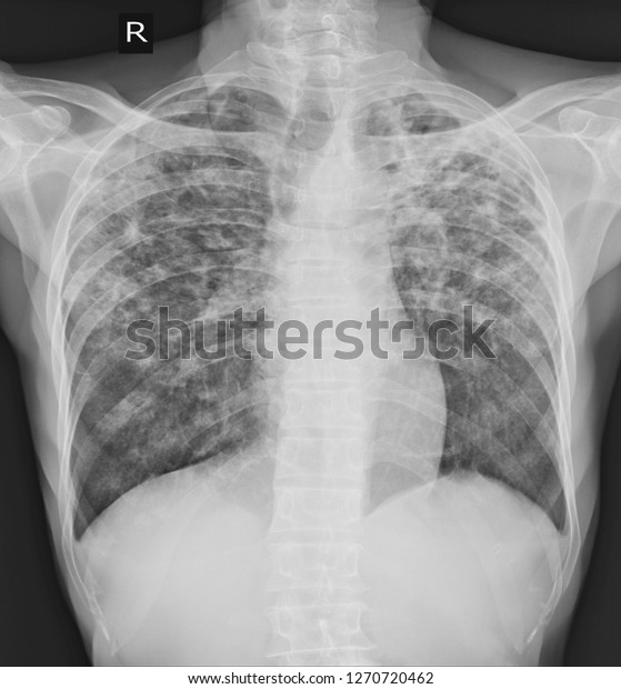 Pulmonary Tuberculosis Tb Chest Xray Old Stock Photo 1270720462 ...