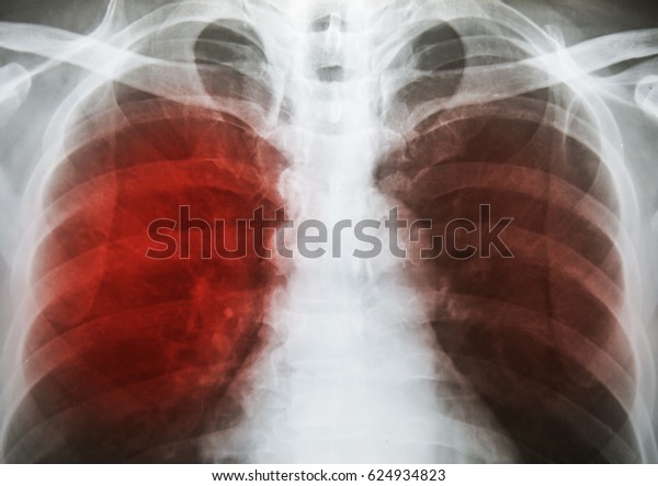 Pulmonary Tuberculosis Tb Chest Xray Show Stock Photo (Edit Now) 624934823