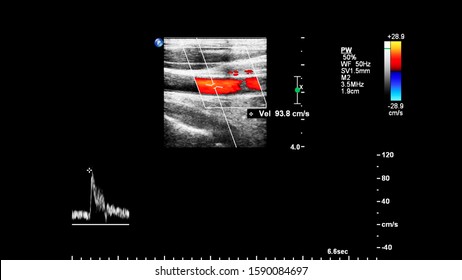 Pulse Wave Doppler Ultrasound Examination.