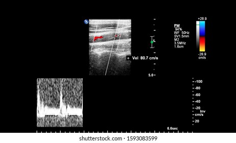 Pulse Wave Doppler Ultrasound Examination Stock Photo 1593083599 ...