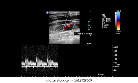 Pulse Wave Doppler Ultrasound Examination Vessels Stock Illustration ...