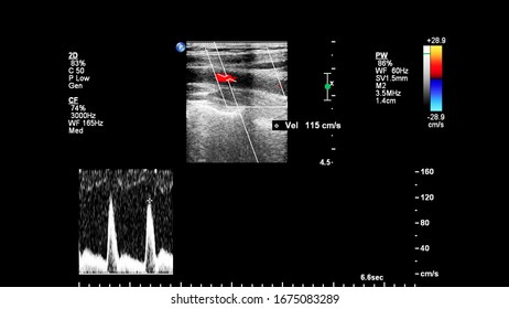 Pulse Wave Doppler Ultrasound Examination Of Vessels.