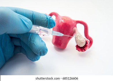 Puncture procedure for egg production, treatment or ovarian stimulation (ovulation induction) in IVF or gynecology photo concept. Doctor pierces anatomical model of ovary  for stimulate or treat - Shutterstock ID 685126606