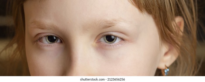 Pupil Dilation In A Child. Myopia. Astigmatism.