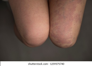 Purple Birthmark On The Knee