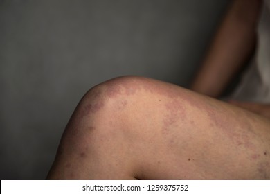 Purple Birthmark On The Knee