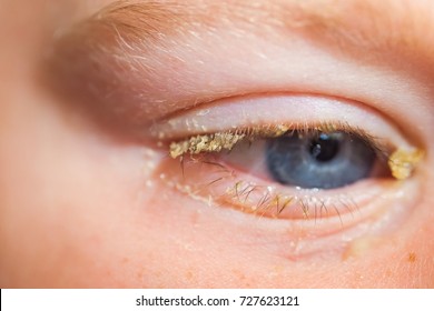 Purulent Conjunctivitis In Children