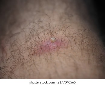 Purulent Furuncle On A Hairy Leg. Big Pimple On The Body Skin