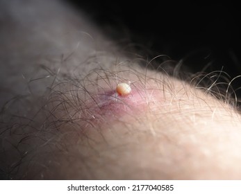 Purulent Furuncle On A Hairy Leg. Big Pimple On The Body Skin