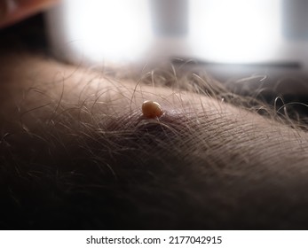 Purulent Furuncle On A Hairy Leg. Big Pimple On The Body Skin