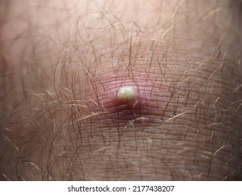 Purulent Furuncle On A Hairy Leg. Big Pimple On The Body Skin