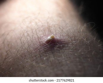 Purulent Furuncle On A Hairy Leg. Big Pimple On The Body Skin