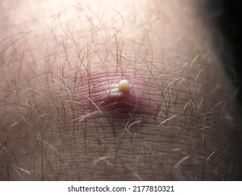 Purulent Furuncle On A Hairy Leg. Big Pimple On The Body Skin