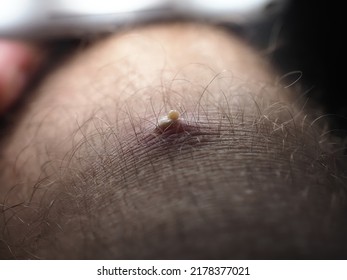 Purulent Furuncle On A Hairy Leg. Big Pimple On The Body Skin