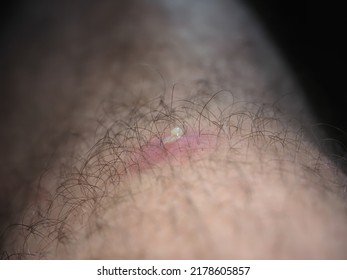 Purulent Furuncle On A Hairy Leg. Big Pimple On The Body Skin