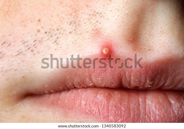 Red Bump On Stomach Acne Or Ingrown Hair Tiege Hanley