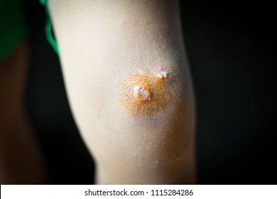 Purulent Pus On Child Knee Black Background