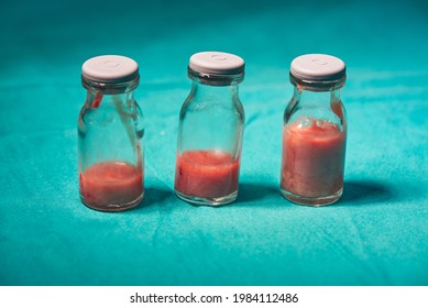 Pus From Brain Abscess In Sterile Bottle For Laboratory Examination