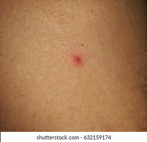 Pustule Folliculitis Stock Photo (Edit Now) 632159174