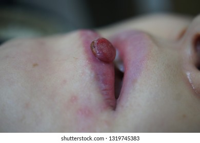 Pyogenic Granuloma Of The Lip