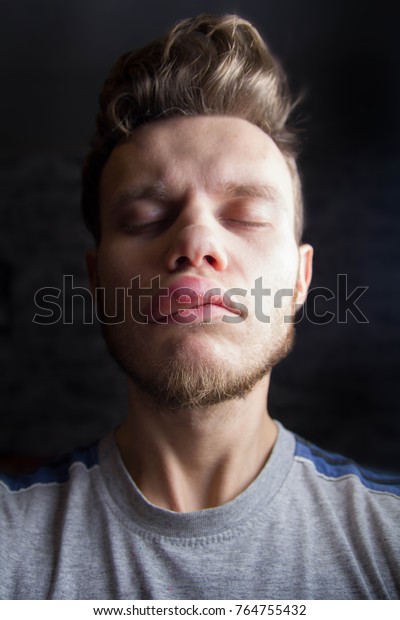 Quinckes Angioneurotic Edema Angioedema Man Stock Photo 764755432 ...