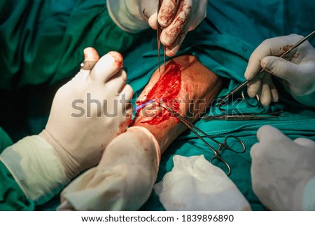 Radial forearm free flap surgery in hospital