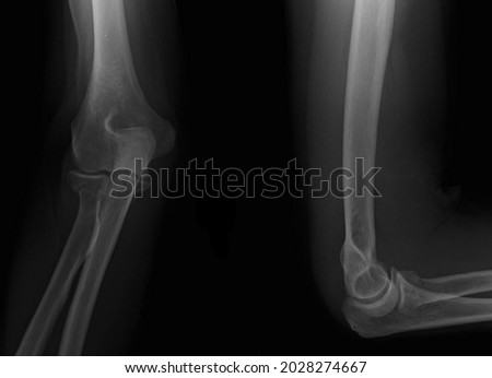 Radial head fracture x ray radiology