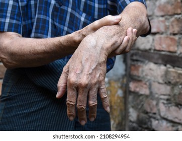 Radial Nerve Injury Or Wrist Drop Of Asian Elder Man.