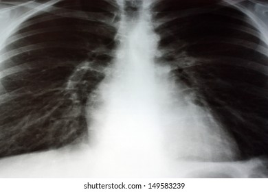 Radiograph Of Chest 