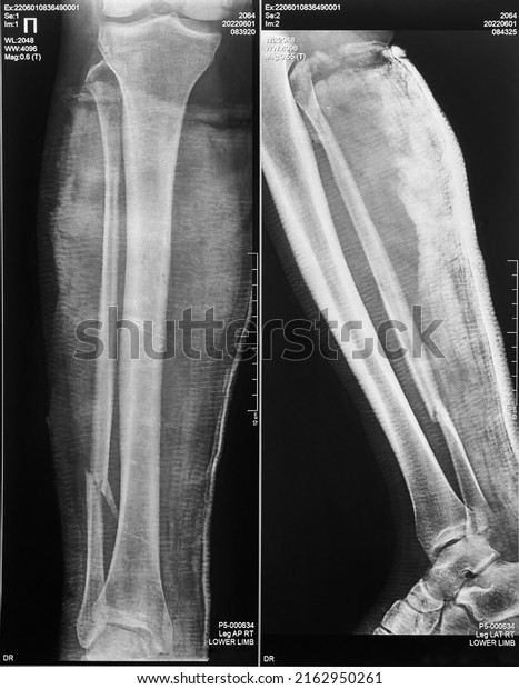 Radiograph of a\
comminuted fracture of the lower leg with displacement and in two\
projections, vertical\
image.