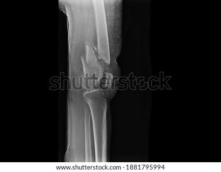 A radiograph of knee showing closed fracture of distal femur with displacement. The patient needs open reduction and internal fixation with plate and screws.
