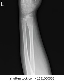 Radiograph Left Forearm Fracture Radius Stock Photo 1531000538 ...