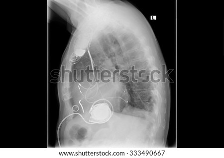 Radiograph left side of the chest. Great Heart with implanted pacemaker system. Below are the pump of the heart assist system.