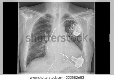 Radiograph left side of the chest. Heart with implanted pacemaker system. Below are the pump of the heart assist system.