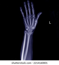 Radiograph of left wrist fracture of distal radius in posterair -anterior position. - Shutterstock ID 2214160001