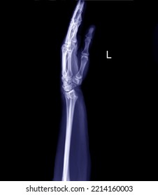 Radiograph of left wrist fracture of distal radius in posterair -anterior position. - Shutterstock ID 2214160003