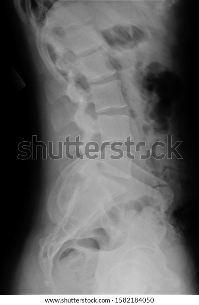 Radiograph Lumbar Sacral Spine Lateral Projection Stock Photo ...